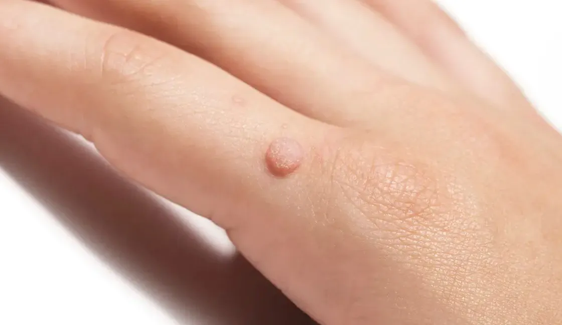 Genital Wart or Mole: Everything You Need to Know