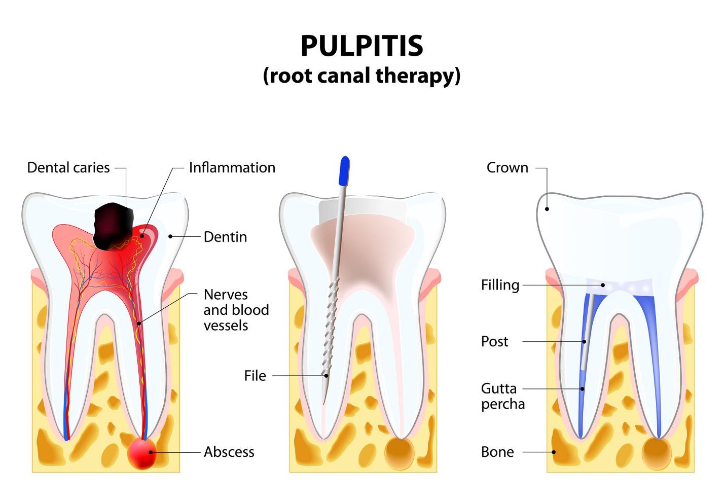 5 Must-Know Facts About Root Canal Treatment