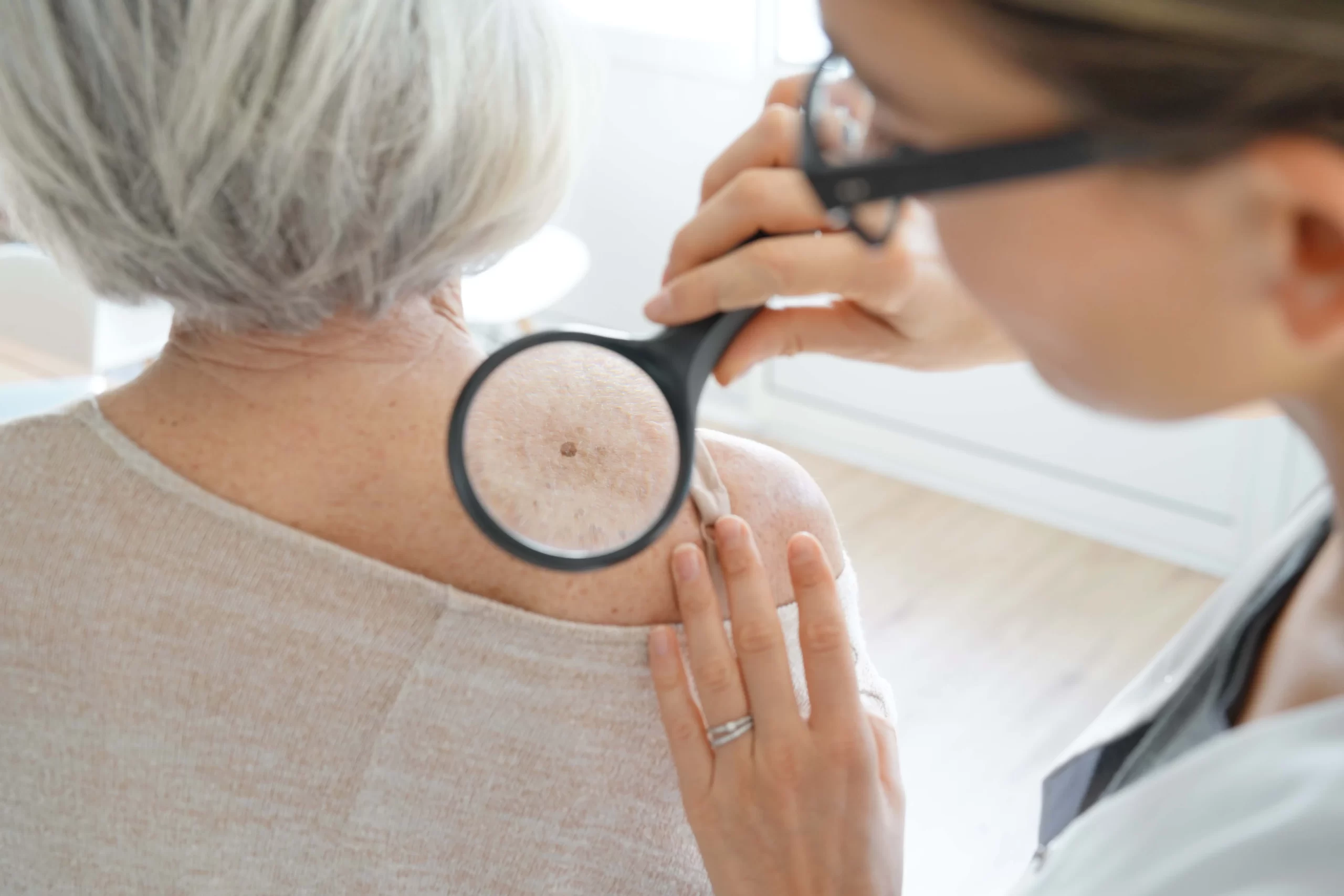 How A Skin Check For Cancer Can Save Your Life 