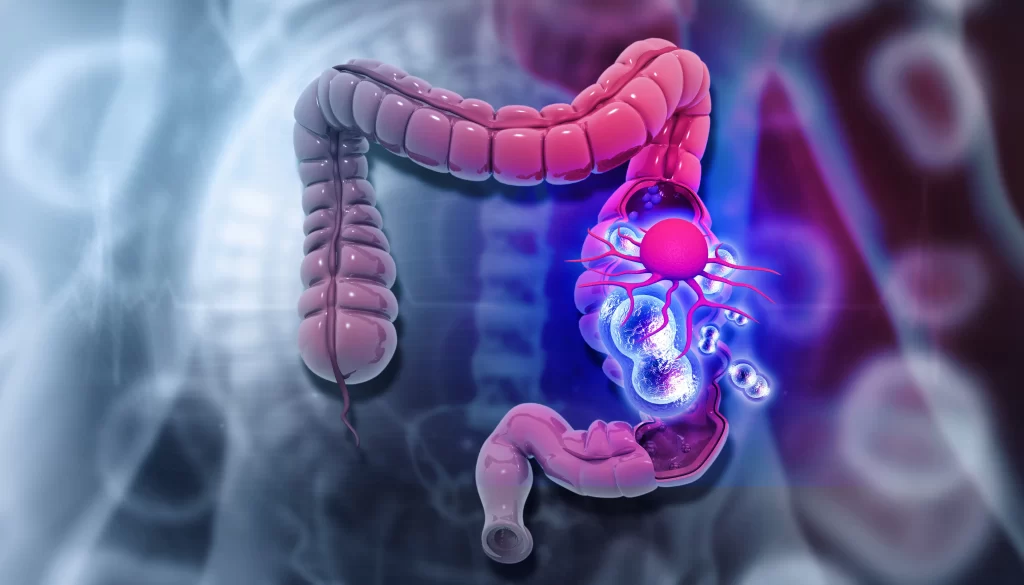 Colorectal Cancer Detection   