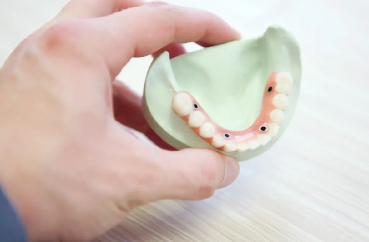 Lower jaw model with implants displayed on a table.