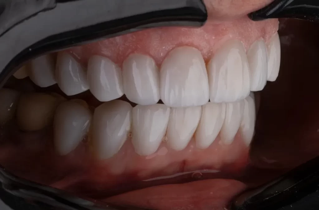 Close-up of white, healthy teeth after dental treatment.